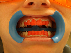 Auftragen des Bleichgels