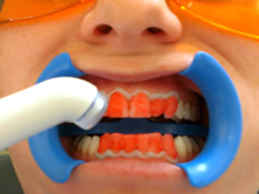 Aktivieren des Bleichgels mittels UV-Lampe